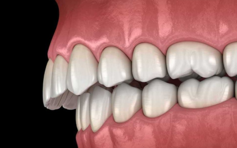 Nhận biết răng hô nhẹ và 4 cách khắc phục