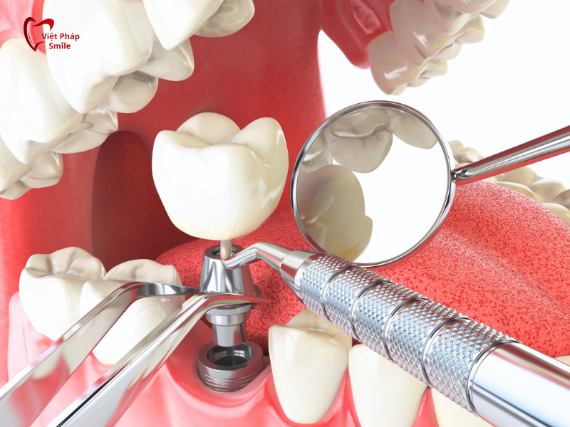 trong-rang-implant-tai-hocmon