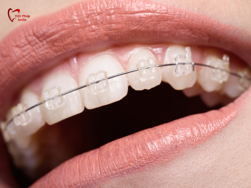Niềng răng tại Gò Vấp