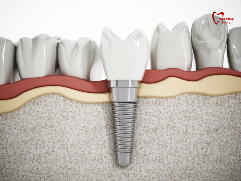 ve-sinh-rang-implant