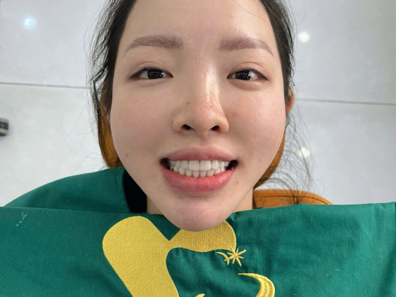 boc-rang-su-dep-tu-nhien