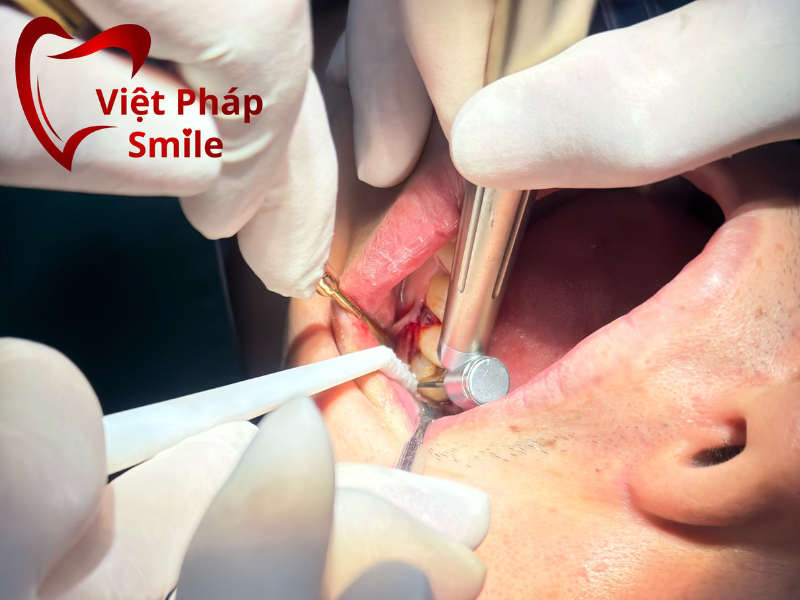 trong rang implant uy tin tai tay ninh