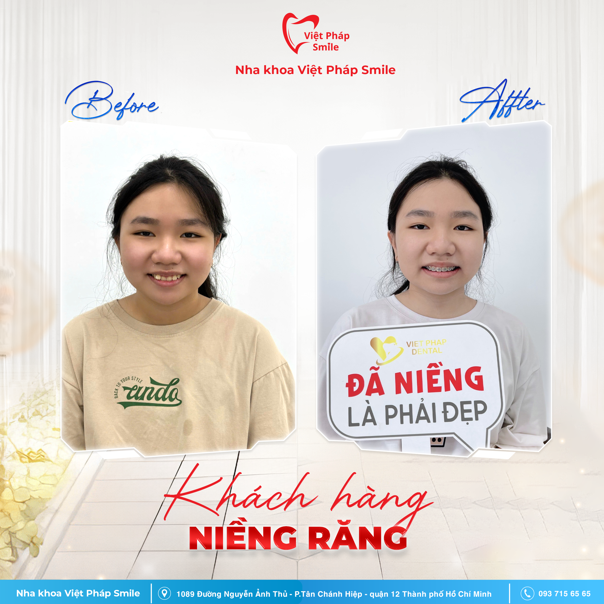 BA niềng răng 1