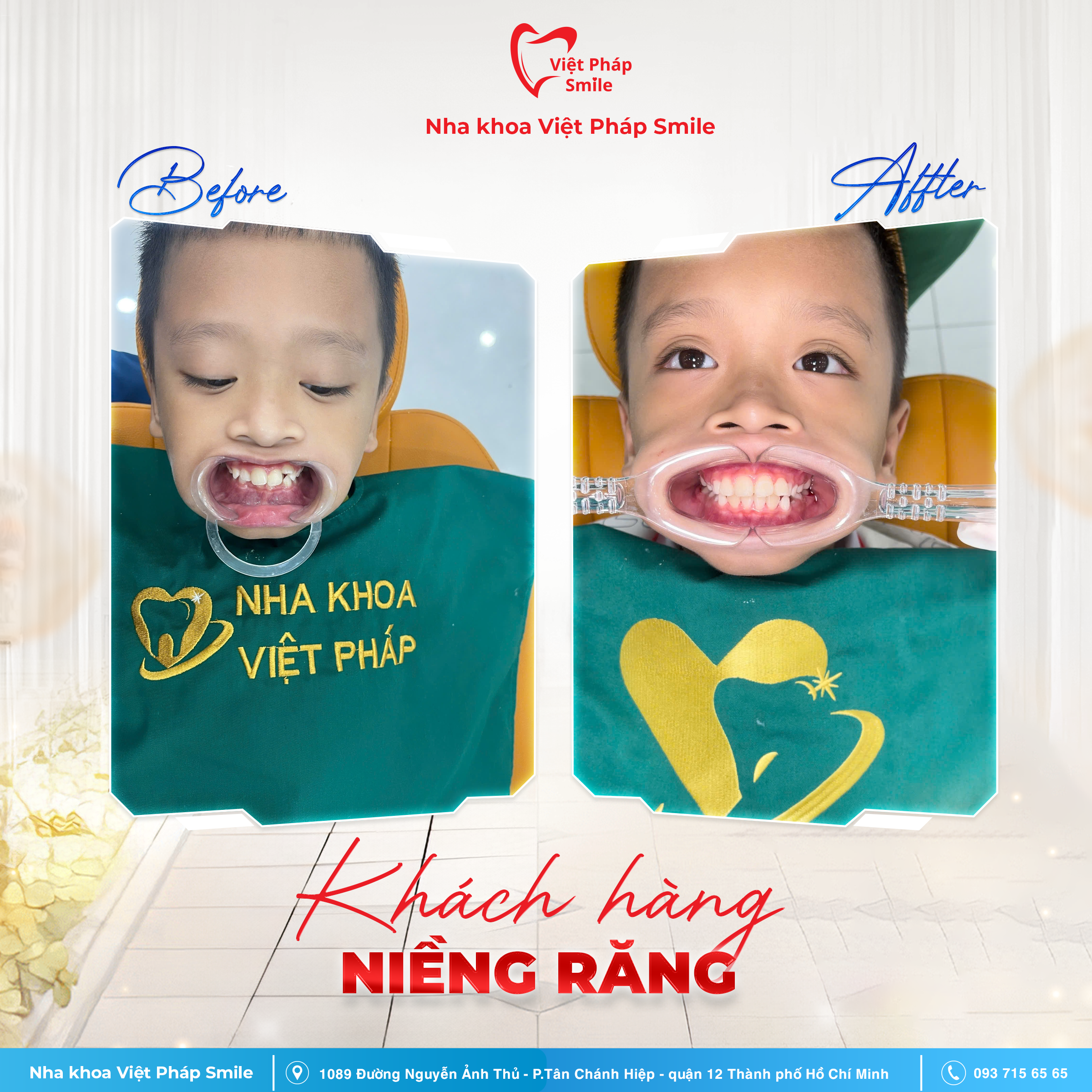 BA niềng răng 3