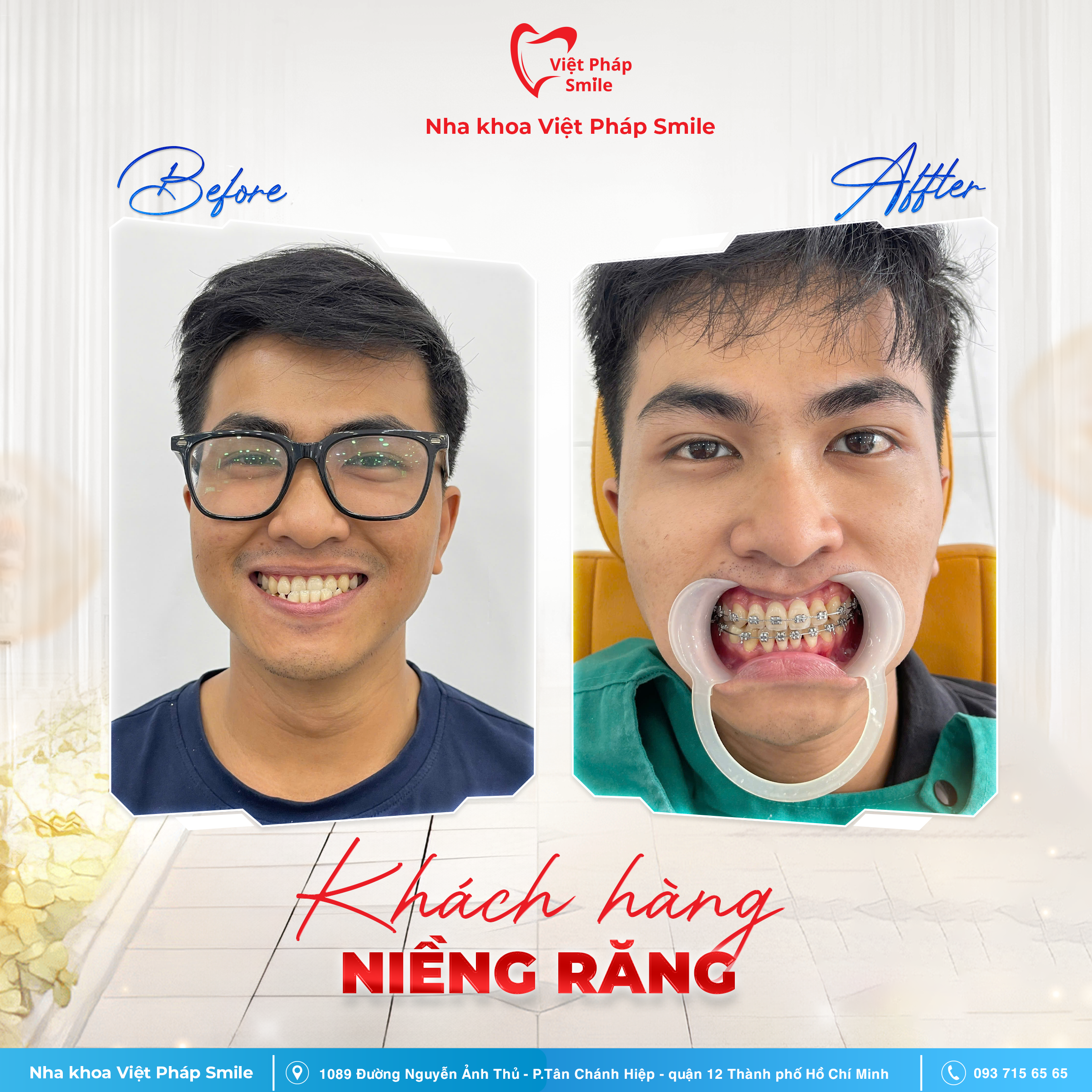 BA niềng răng 4