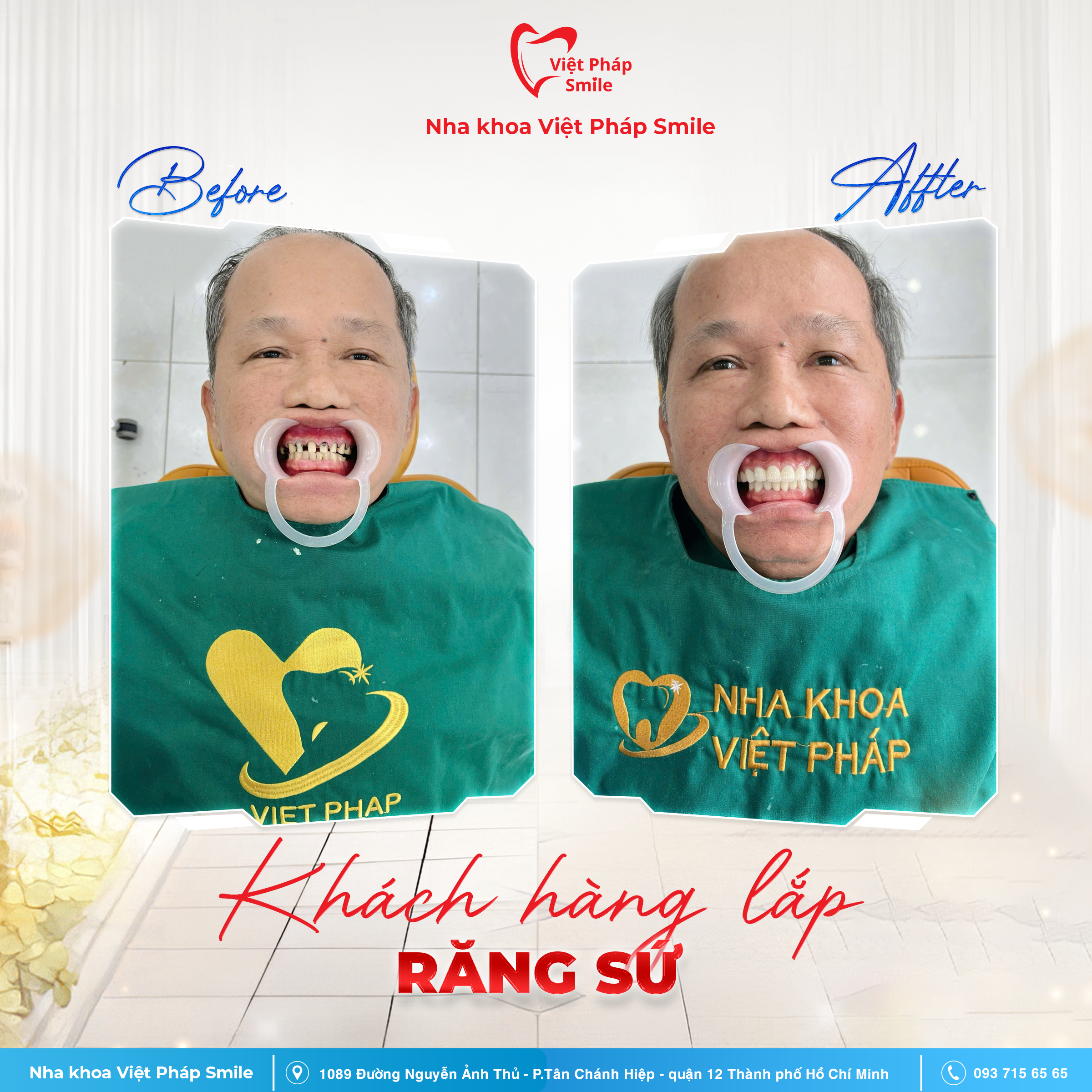 Bọc răng sứ thẩm mỹ 2