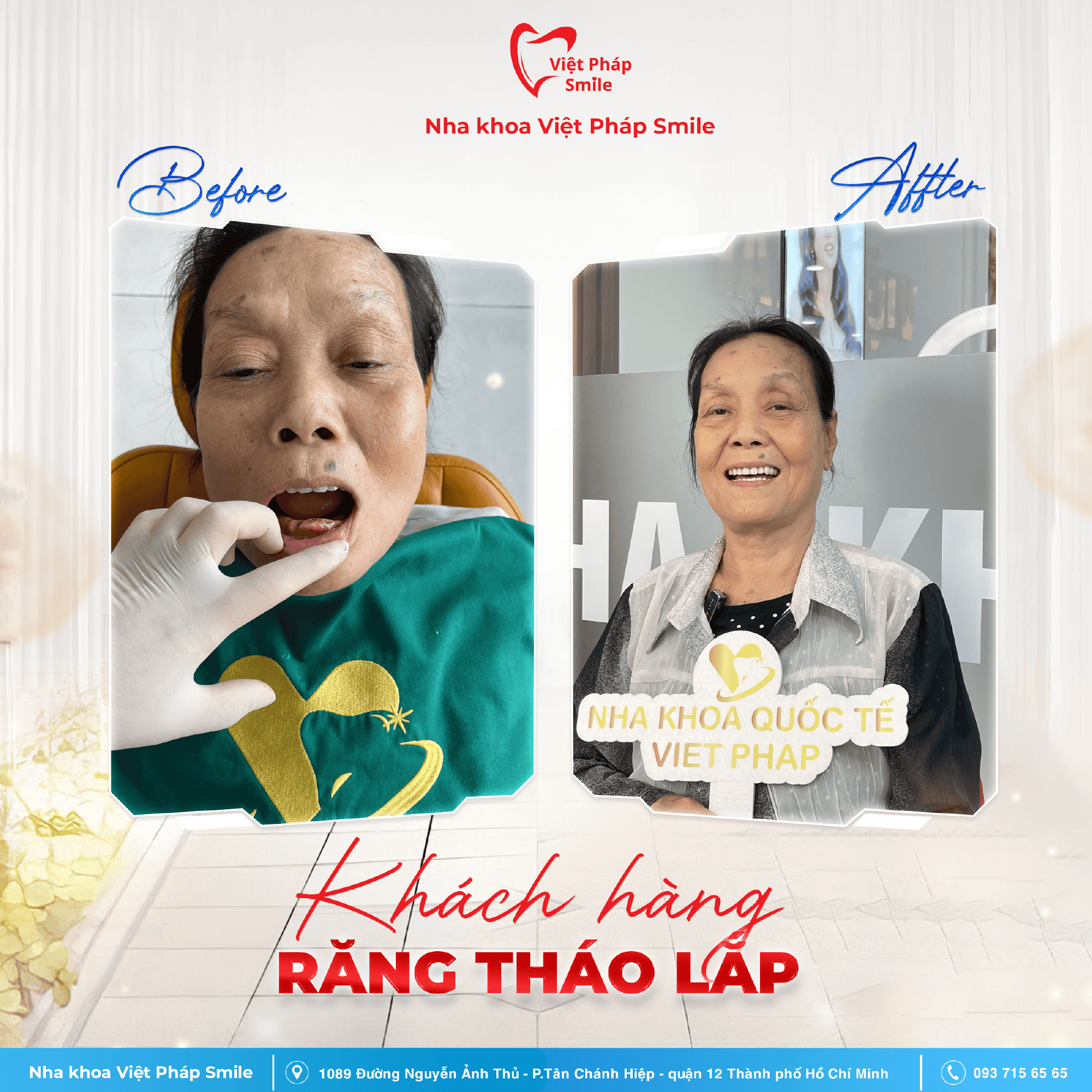 BA răng tháo lắp1,2-02 3