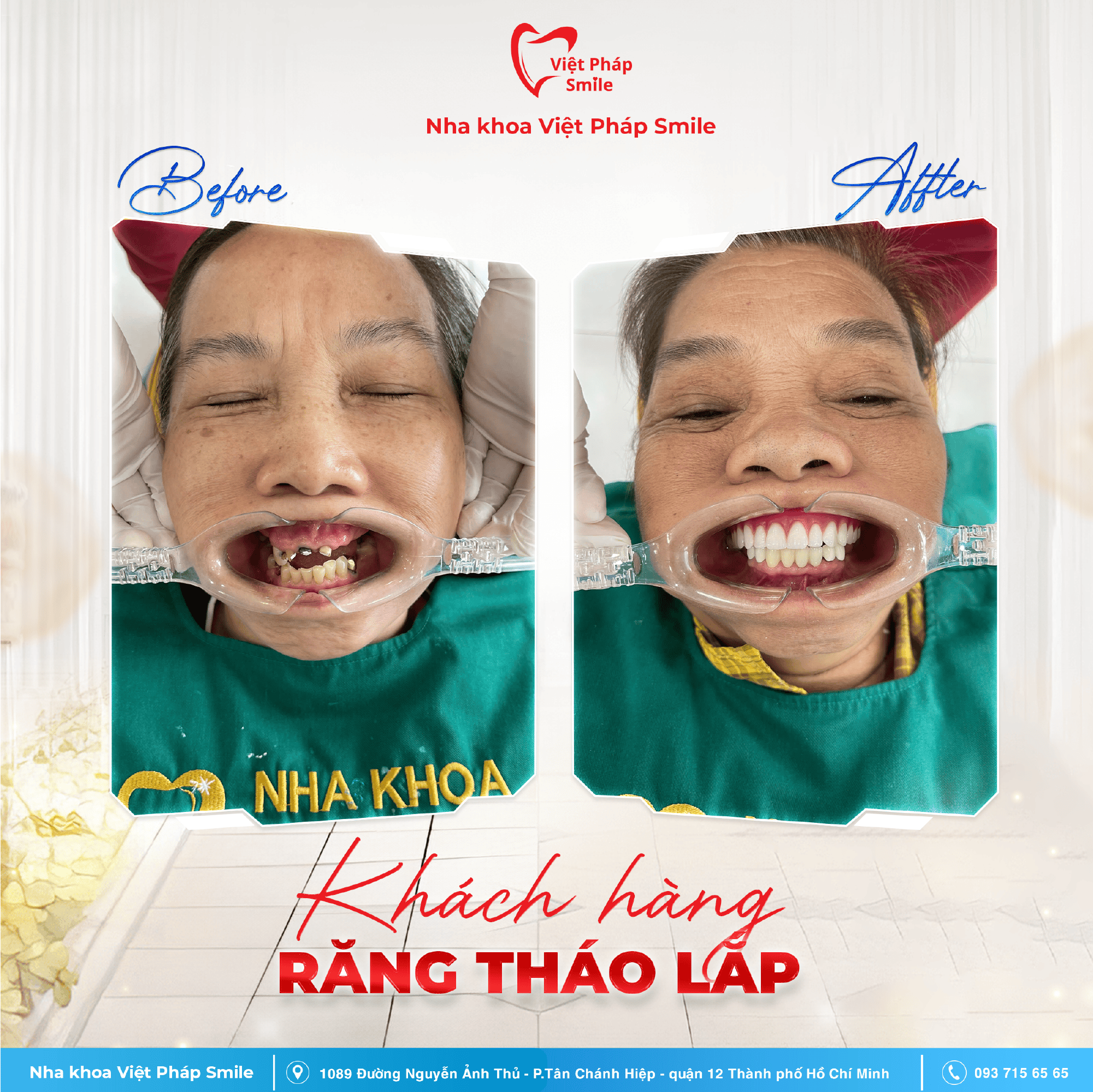 BA răng tháo lắp1,2-02