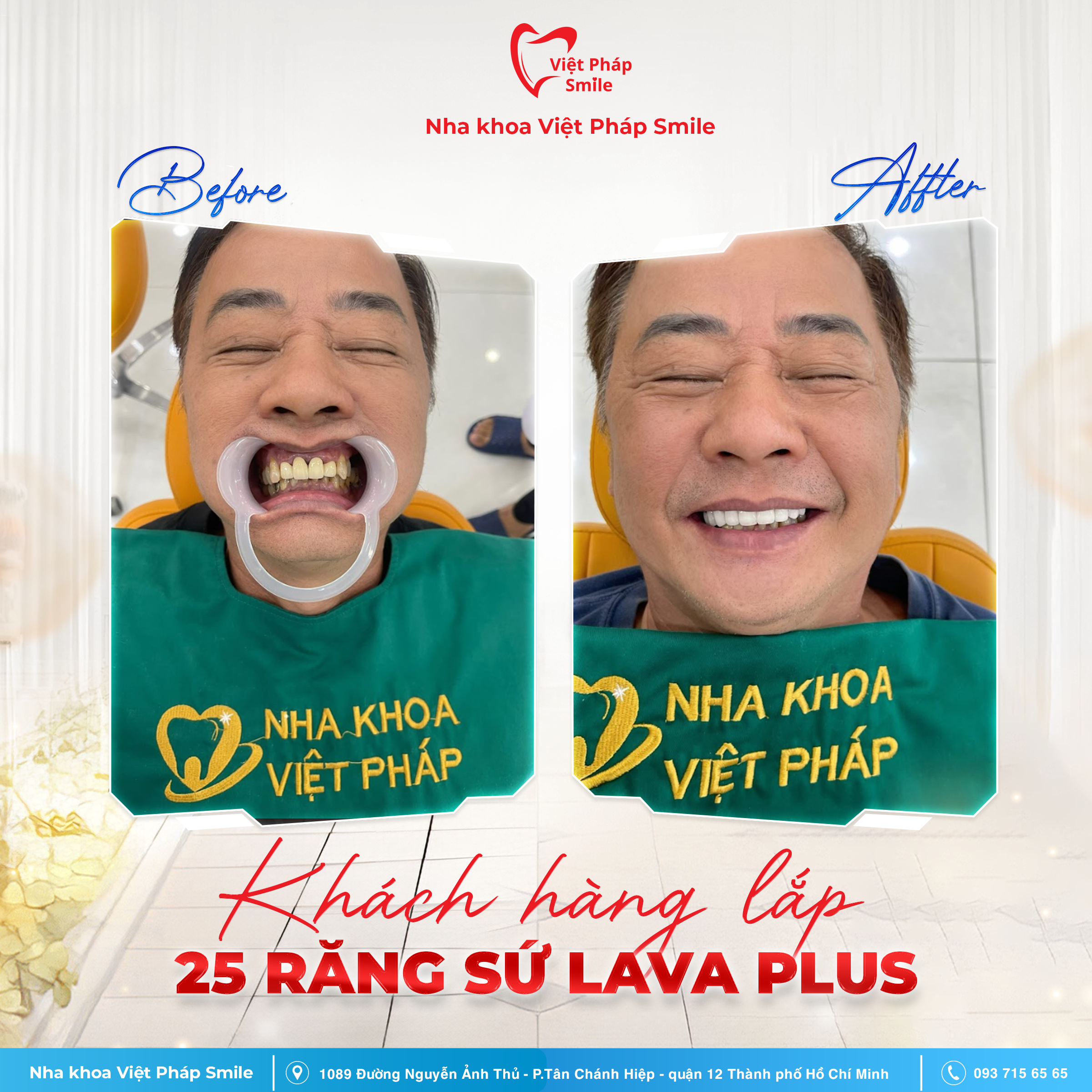 Bọc răng sứ thẩm mỹ 1