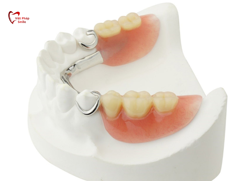 Hàm tháo lắp dạng Attachment (bán phần)