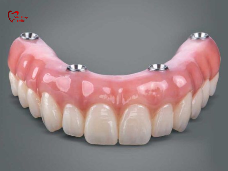 Hàm tháo lắp trên trụ Implant (toàn phần)