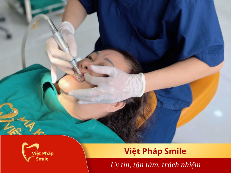 Trám răng thẩm mỹ tại Nha khoa Việt Pháp Smile 1