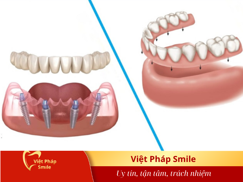 Ưu và nhược điểm của hàm tháo lắp so với cầu răng và implant