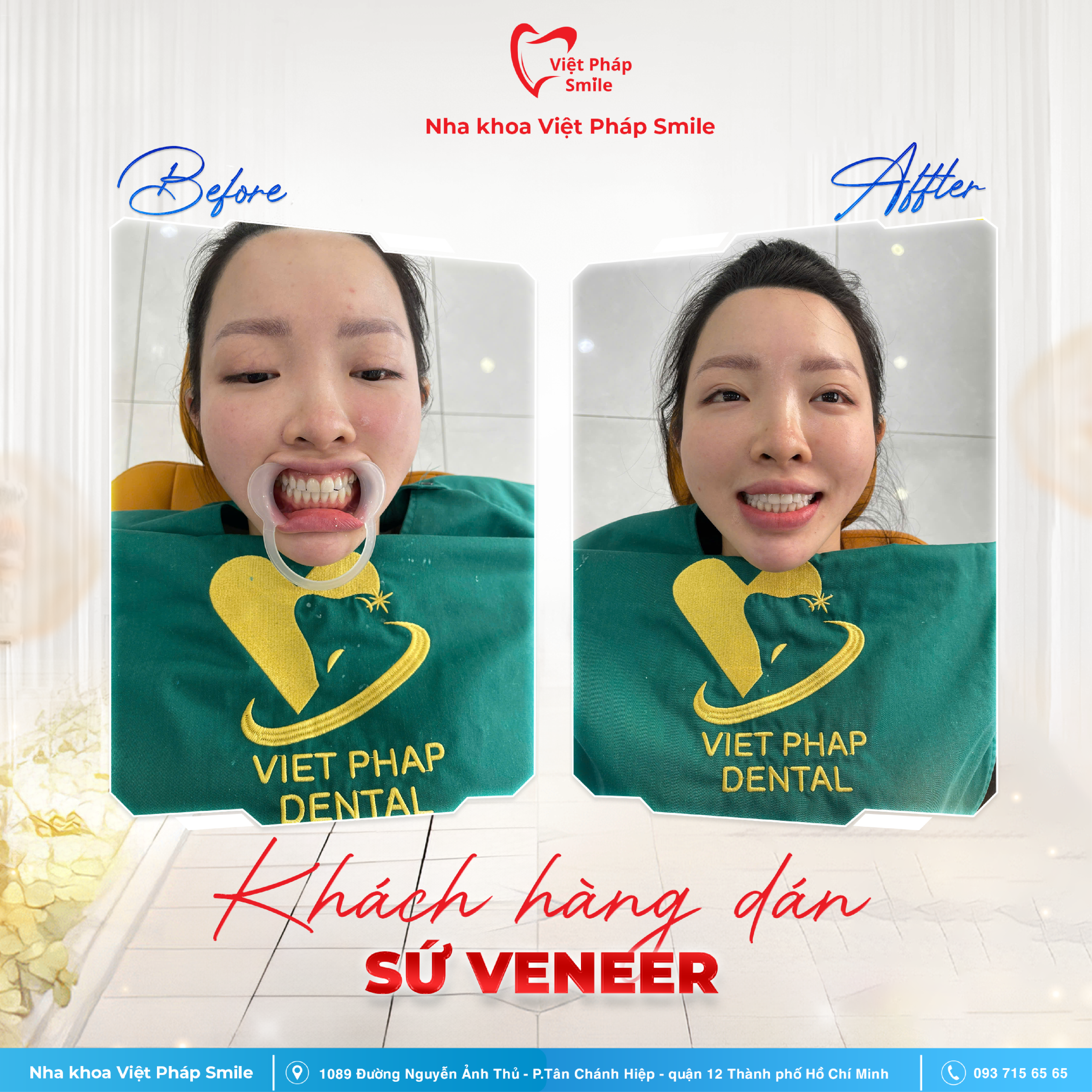 Dán sứ Veneer 1