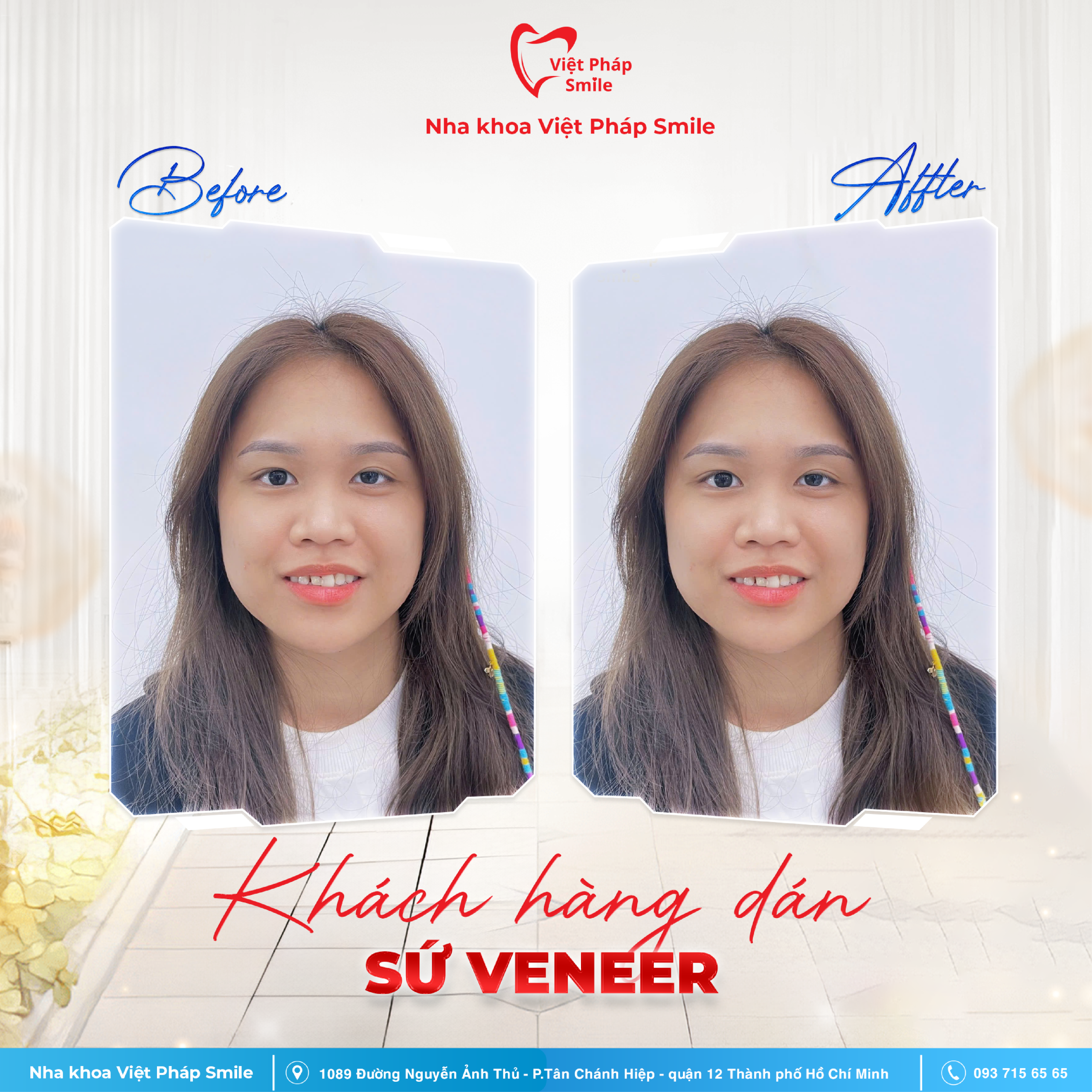 Dán sứ Veneer 2