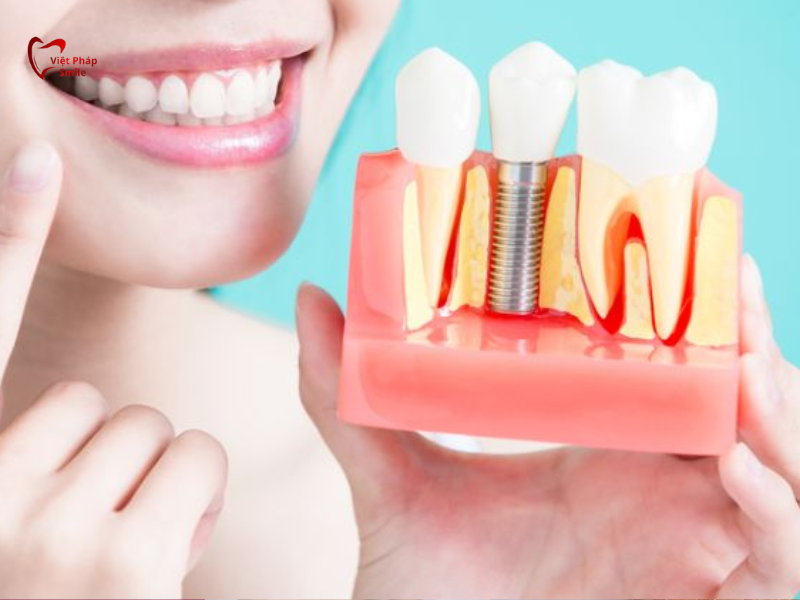 cham-soc-rang-implant